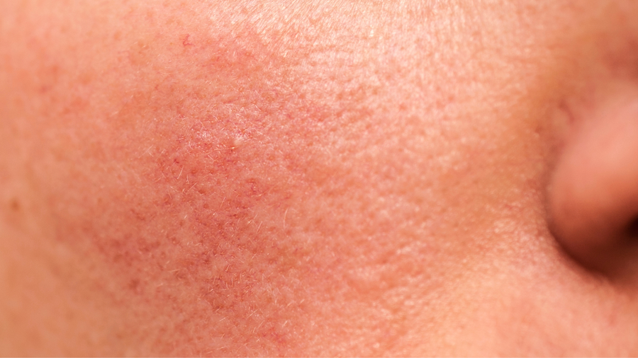 How to Tell If Your Skin Barrier Is Damaged (And What to Do About It)