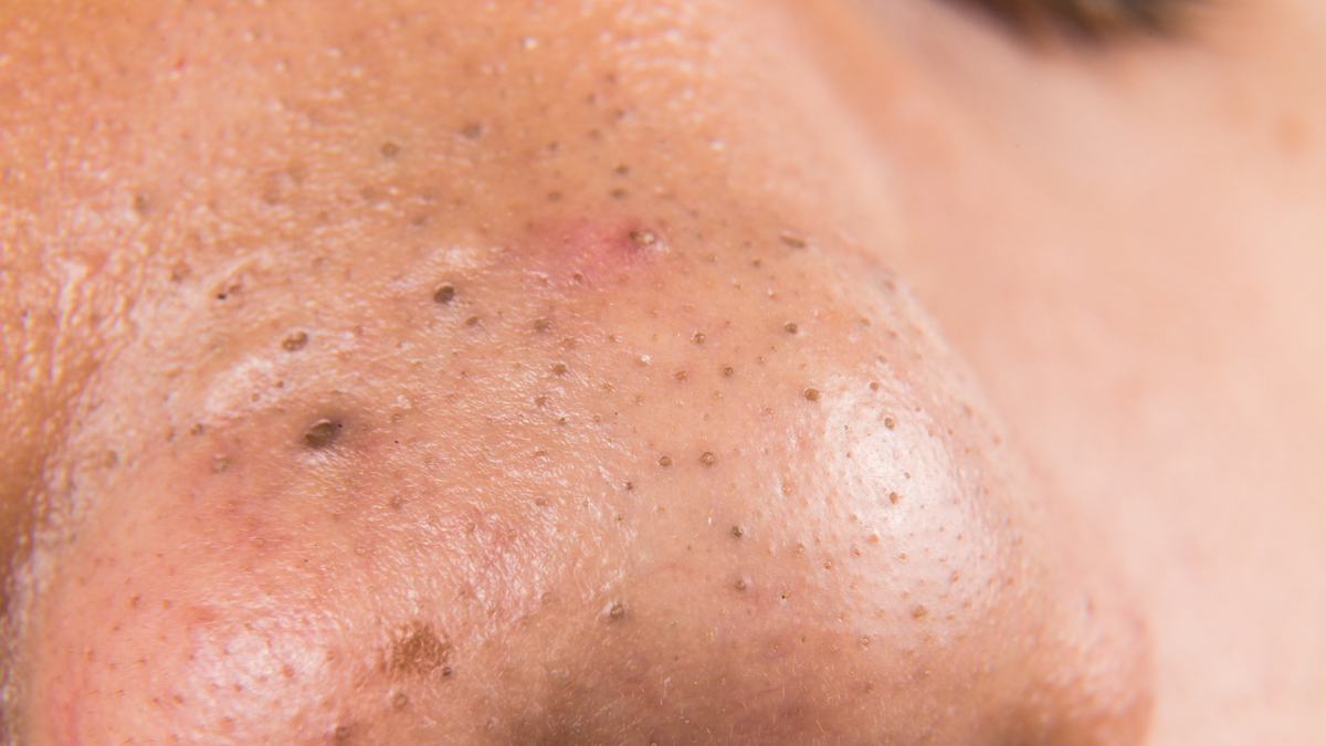How to Remove Blackheads Without Damaging Your Skin