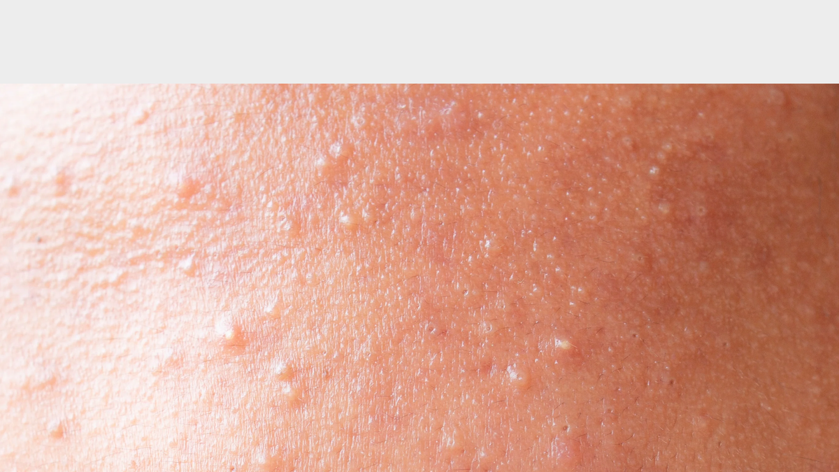 What Causes Clogged Pores and How to Treat Them (Without Overcomplicating Your Routine)