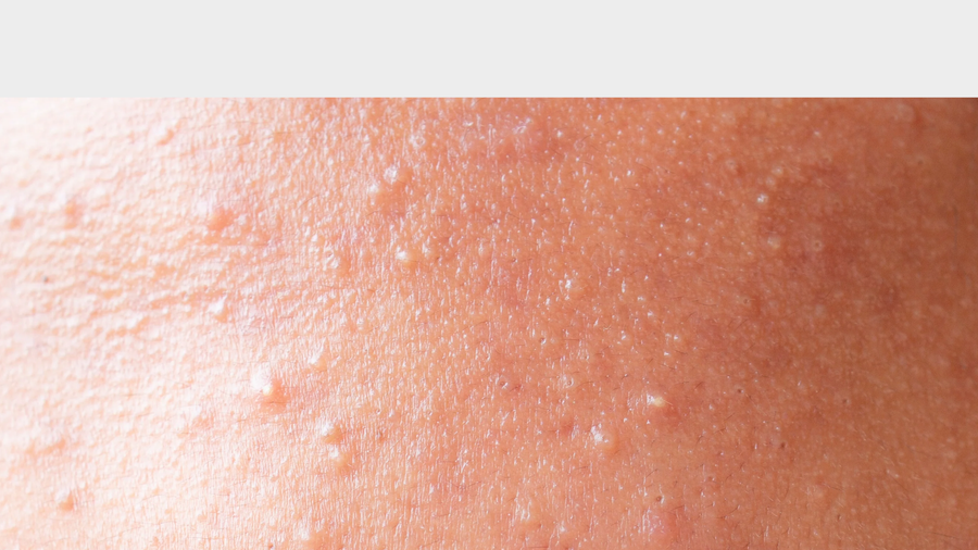 What Causes Clogged Pores and How to Treat Them (Without Overcomplicating Your Routine)