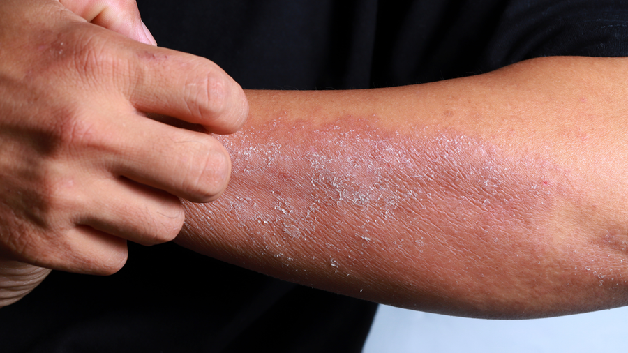 Eczema Explained: Causes, Symptoms, and How to Treat It